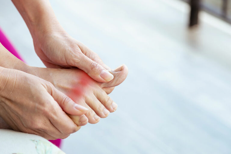 Gout – Diagnosis, stages, and prevention